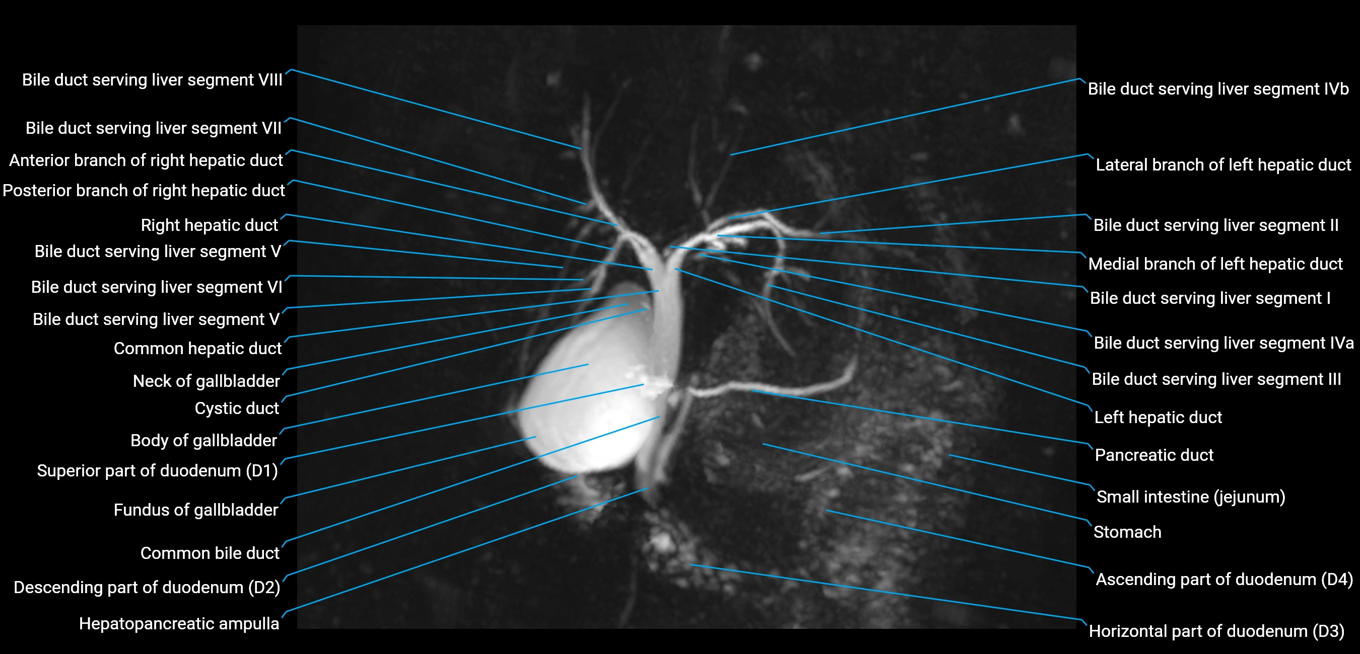 MRCP MIP MRI  anatomy labelled image-img-01003-00015.webp